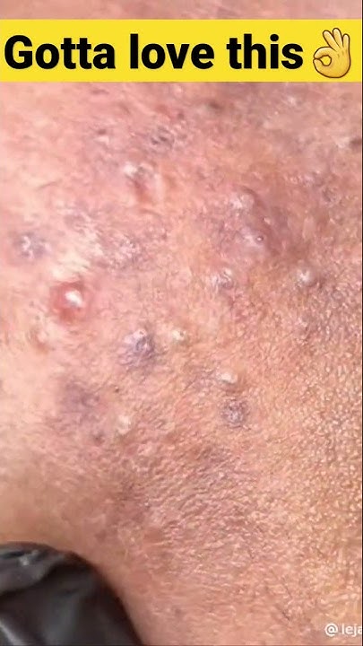 Let's pop some PIMPLES 💦 popping HUGE blackheads and pimples | pimple ...