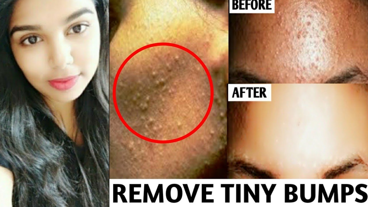 How to get rid of tiny bumps (small pimples) on face, natural home remedy |...