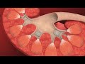 Singe use Video Ureteroscope
