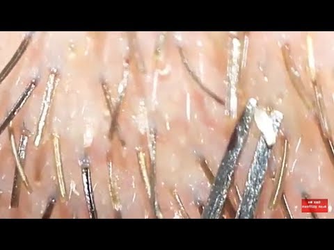 Keratosis Pilaris By My Own Amazing Body