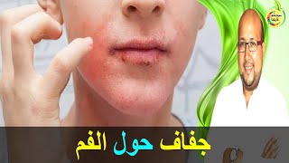 أسباب جفاف الجلد حول الفم وطرق علاجه   -   الدكتور عماد ميزاب   -