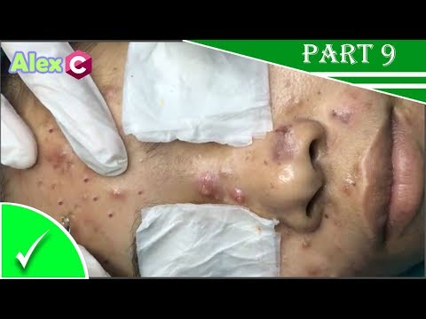how to removal big pimple popping| Cystic acne extraction skincare fda