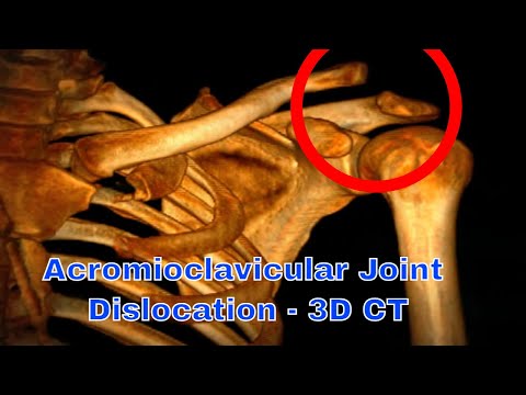 Acromioclavicular joint dislocation - Shoulder CT and 3D CT