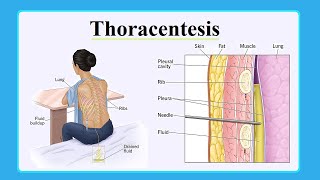 thoracentesis