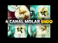 [36] Live Root Canal: 4 Canal Molar Endo on Abscessed Tooth