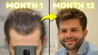 How I Regrew My Hair Using 3 Proven Treatments (Month-by-Month Results)