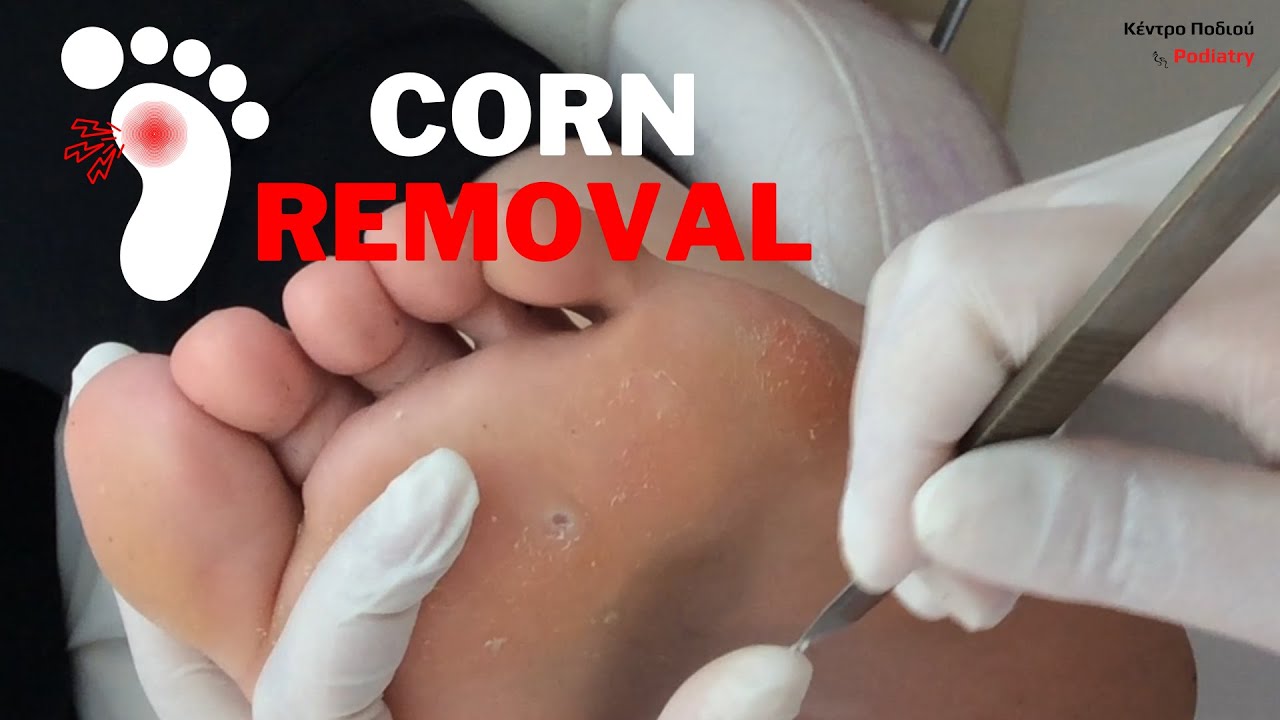 Corn revealed underneath callusRemovalΑφαίρεση κάλουΠοδιατρική