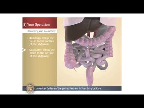 Colostomy/Ileostomy: Your Operation