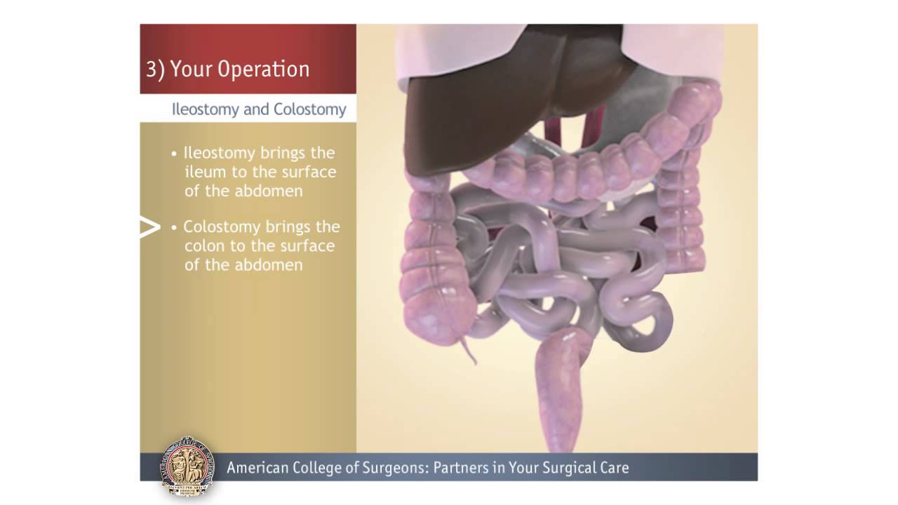 Colostomy/Ileostomy: Your Operation - YouTube