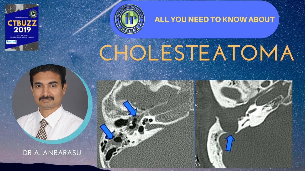 TMT Cholesteatoma Imaging  by Dr Anbarasu A