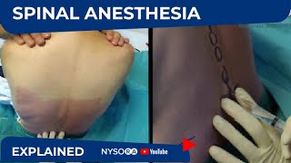 NYSORA Students Educational Videos: Spinal Anesthesia