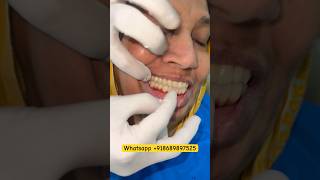 Full Mouth Dental Implant With Fix Teeth #ulwe #navimumbai #mumbaidentalulwe