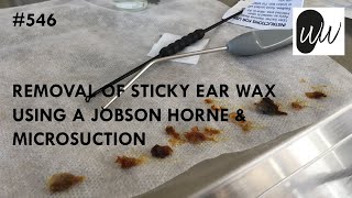 546 - Removal of Sticky Ear Wax using a Jobson Horne & Microsuction