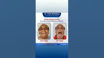 Mouth Opening Surgery in a case of Oral Submucous Fibrosis 📞+91 7825020202 #shorts #shortsvideo
