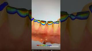 Tooth Wear In Only 8 Months Can Be Prevented With Invisalign With A Better Bite