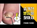 (Eng)엄청난 고통! 무좀발톱으로 내성발톱까지 온 케이스(ft. 스케일링) l Fungal/Ingrown toenails [NP케어]