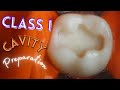 Class I Cavity Preparation ⚪️ First Mandibular Permanent Molar 🟢