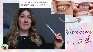 Bleaching my teeth with dentist bleaching trays - my experience and review