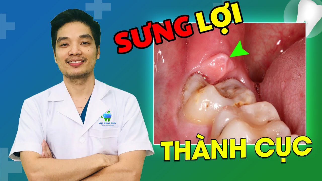 Outline Video Tại Sao Sưng Lợi Thành Cục Ở Chỗ Răng Hàm? Cách Xử Lý Thông Minh