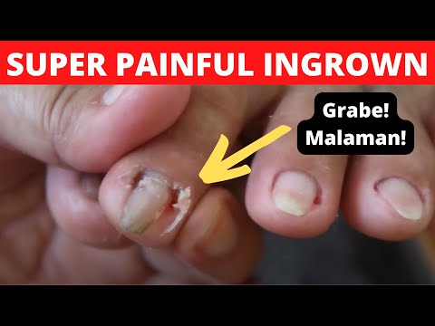 iNGROWN TOENAIL REMOVAL | Alma&rsquo;s Manicure and Pedicure Vlogs Philippines