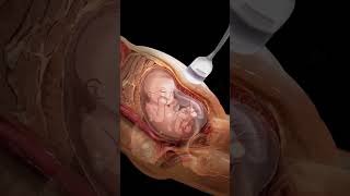羊水穿刺演示#baby