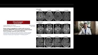 Лекція &quot;Пухлини головного мозку&quot; Романуха Д.М. Walter E. Dandy Neurosurgical Club - Ukraine