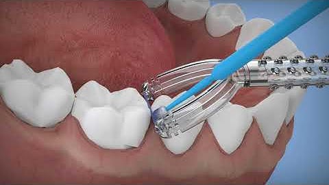 How To: Use SDFlosser®