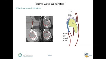 Sponsored Symposium | Advanced CT applications for structural heart disease interventions