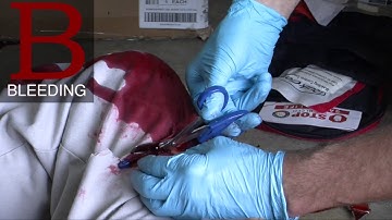 Severe Bleed Control Example Video.
