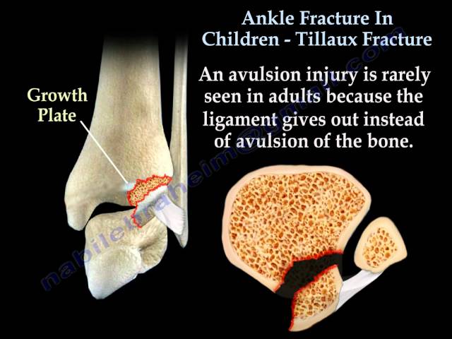 Different Types of Fractures - What You Need to Know - Siora Surgicals Pvt.  Ltd.