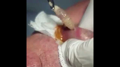 Удаление личинки мухи из губы