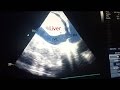 IVC ultrasound