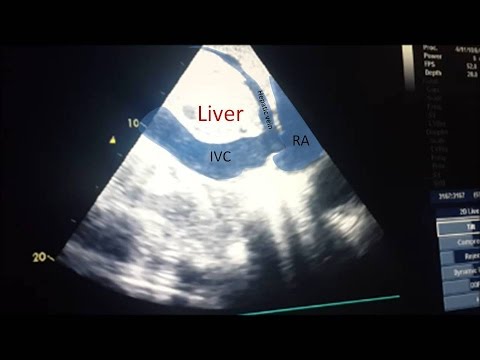 IVC ultrasound