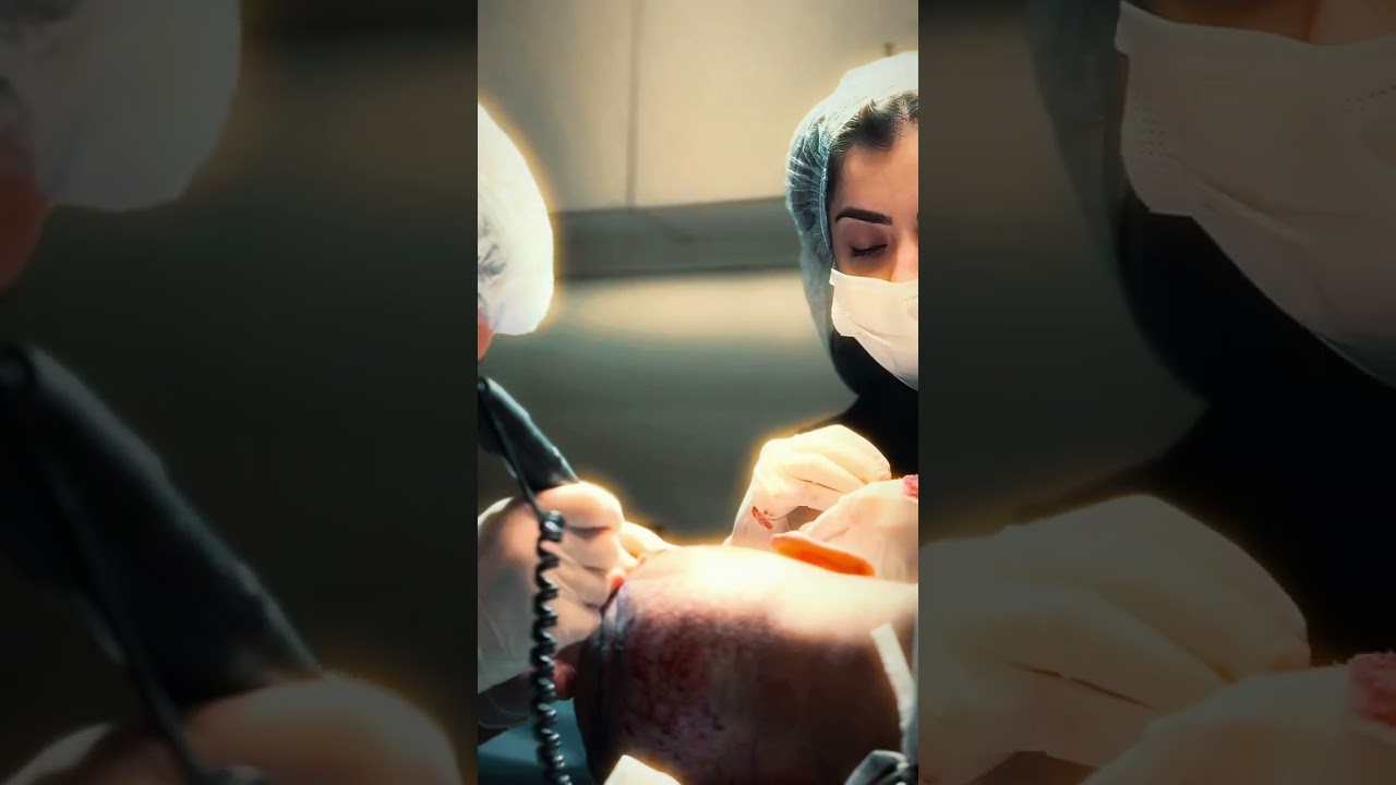 Watch Before Getting a Hair Transplant!