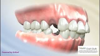 4 Pre Molar Extractions for bimaxillary protrusion