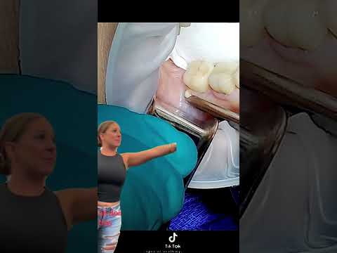 Lady on airplane vs Abscess