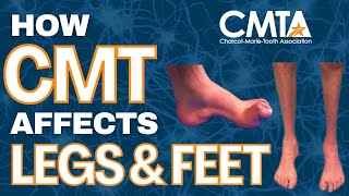 How Charcot-Marie-Tooth Disease Cmt Affects Legs & Feet Why Ankle-Foot Orthoses Afos Matter