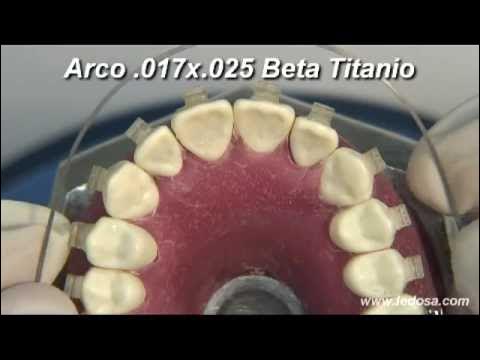 Para que sirven las dobleces finales en los arcos ortodóncicos o colitas? -  Dental Cuba