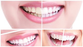 بمكون واحد تبييض الأسنان إزالة اصفرار الأسنان علاج اللثة وإزالة رائحة الفم الكريهة في مدة قصيرة
