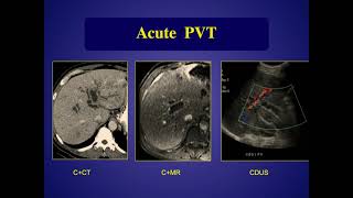 Doppler Evaluation of Portal Hypertension screenshot 2