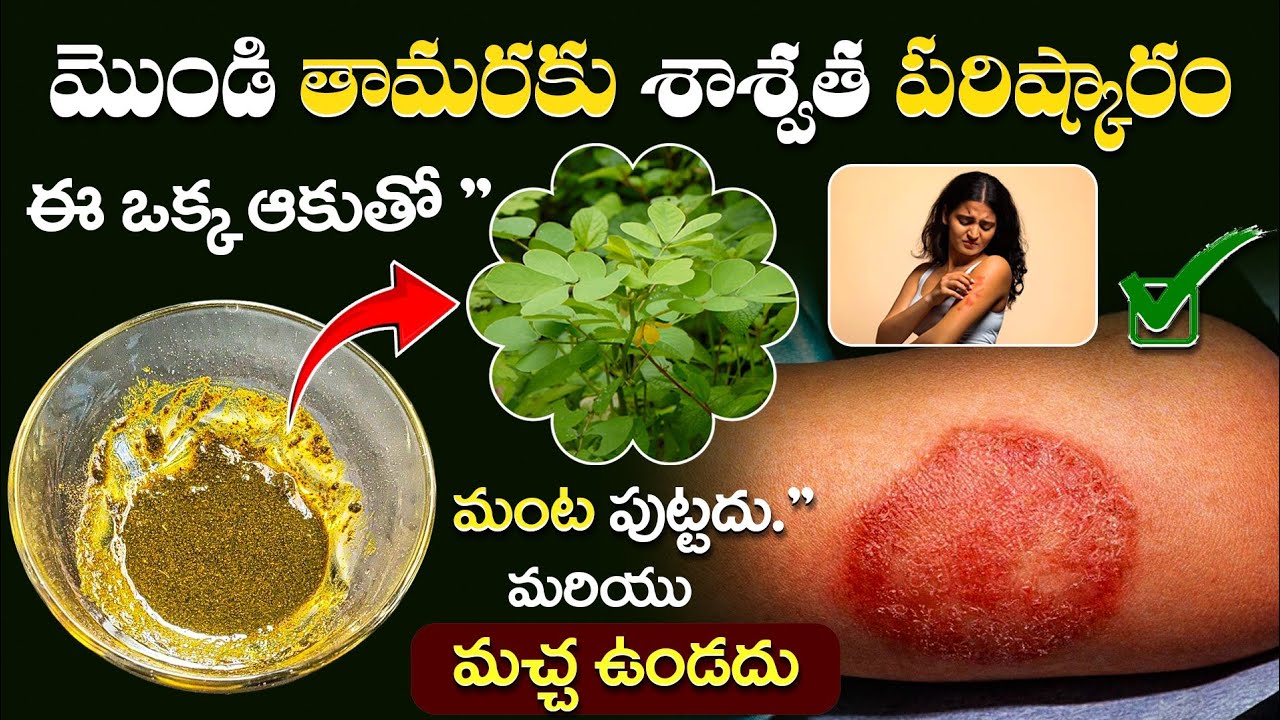 ఈ ఒక్క ఆకుతో మొండి తామరకు శాశ్వత పరిష్కారం? 😲 | మచ్చ లేకుండా, మంట లేకుండా Natural Remedy | Skin Care
