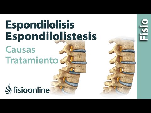 Vídeo: Espondilolistesis: Síntomas, Causas Y Tratamiento