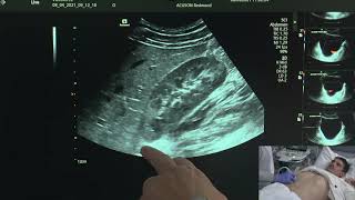 Ultrasound of the Urinary Tract