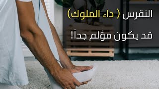 النقرس: هل يمكن الوقاية منه؟