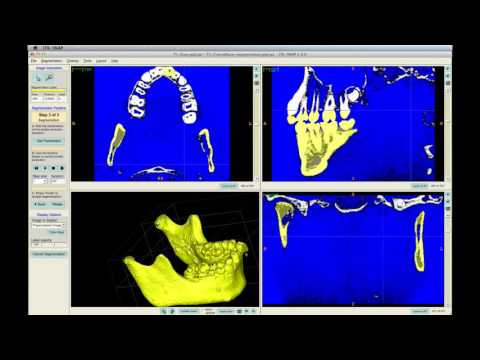 3E: Construct the Segmentation of the Mandible