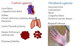 Cyanosis Symptoms and Causes. Central and Peripheral Cyanosis