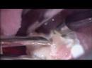Coblation Tonsillectomy