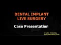 Today&#39;s LIVE dental implant surgery telecasted on Facebook