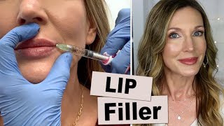 My Experience Getting Lip Filler for Vertical Wrinkles!