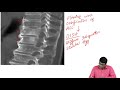 Ankylosing Spondylitis Vs DISH